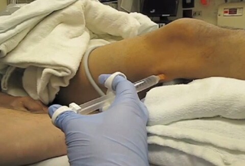 Ultrasound-guided popliteal sciatic block for foot abscess