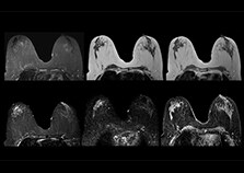 clinical cases 3 breast mri on multiva