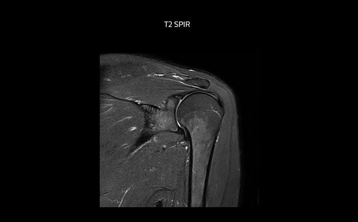 Shoulder MRI with high quality, T2 SPIR