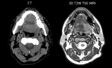 Comparison of CT simulation scan