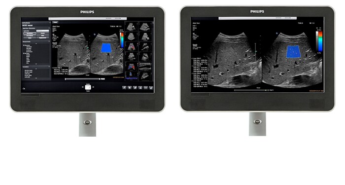Viewing area comparison with an ElastQ ultrasound image on screen