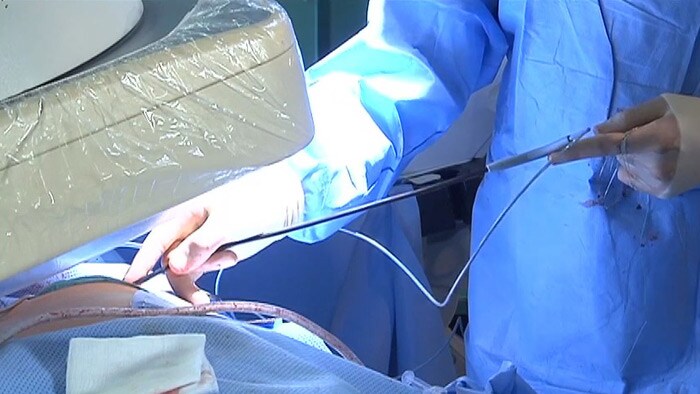 Case review: Minimally invasive percutaneous lead extraction with an excimer laser video