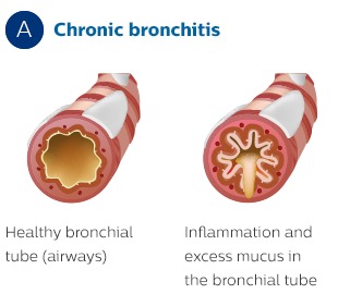 Effect of Chronic Bronchitis on Bronchial Bronchitis