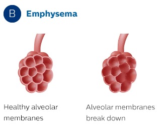 Effect of pulmonary emphysema on alveoli