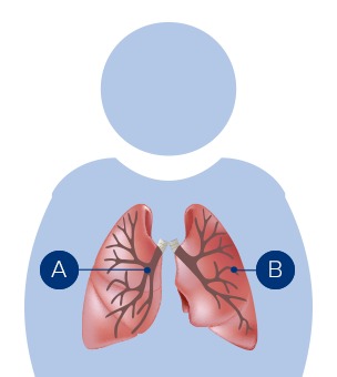 An illustration of the lungs