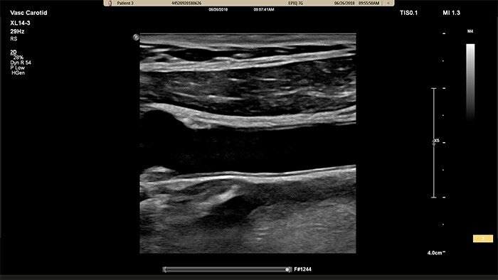 Example of an image retrieved with Philips XL14-3 xMATRIX linear array transducer vascular ultrasound