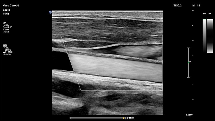 MicroFlow Imaging vascular ultrasound Arterial example