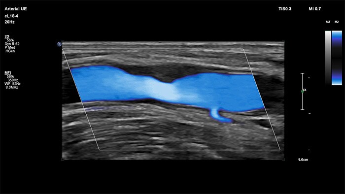 MicroFlow Imaging vascular ultrasound