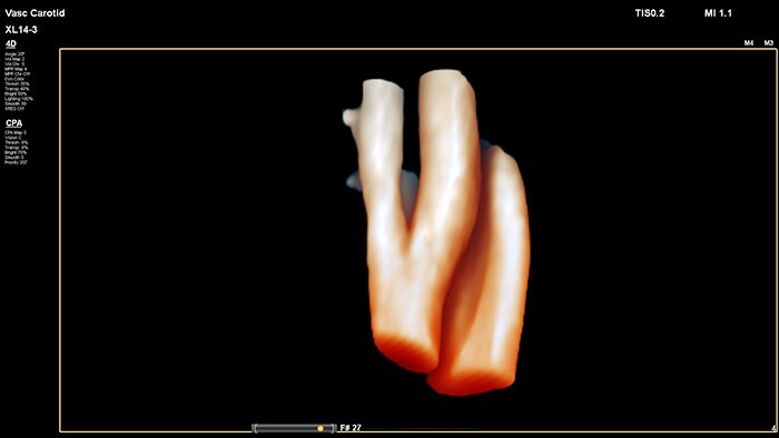 Example of a 3D vessel cast image retrieved with Philips XL14-3 xMATRIX linear array transducer vascular ultrasound