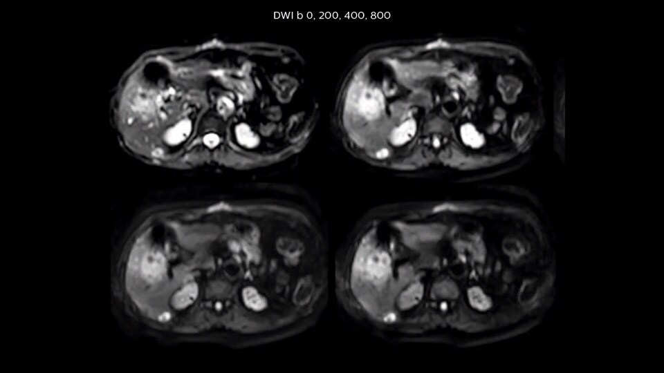 Bremen Case2 2 liver MRI 960px